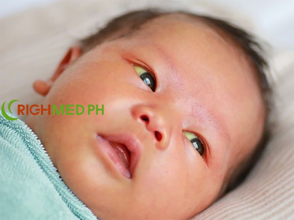 Trẻ sơ sinh bị vàng da cần được xác định rõ nguyên nhân để có phương pháp điều trị phù hợp